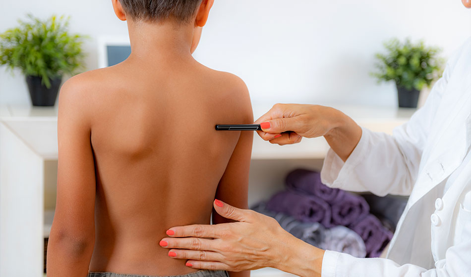 escoliose infantil quando a curvatura da coluna exige investigacao neurologica