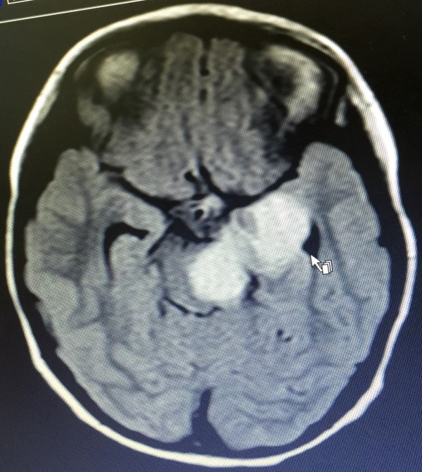 imagem tumor cerebral pediátrico1