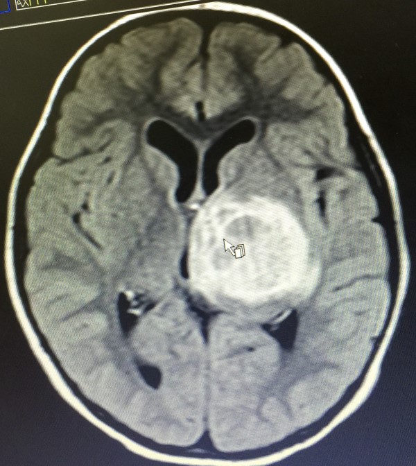 imagem tumor cerebral pediátrico